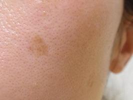 札幌で「シミ」にお悩みならラボーテへ。