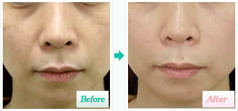 簡単にリフトアップしたいですよね？