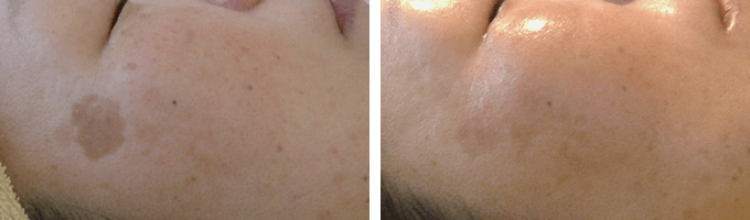 自分でできるシミ対策